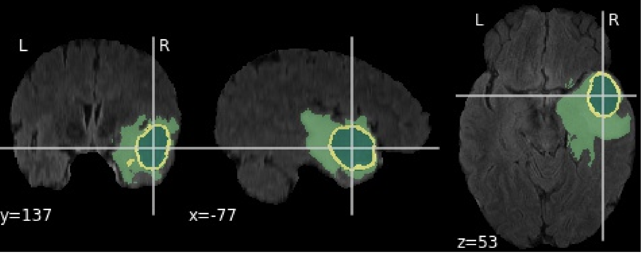 Three brain MRI views with green and yellow segmentation overlays